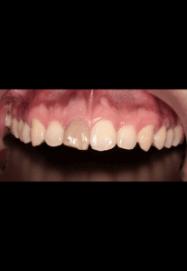 cirugia_dental03