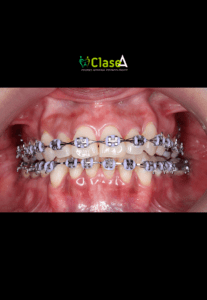 ortodoncia con tratamiento de brackets