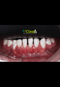 periodoncia01